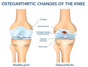 Osteoarthritis Pain Treatment Injection Syringe