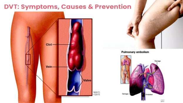 DVT: SYMPTOMS, CAUSES, AND PREVENTION