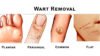 Best Sellers in Wart Removal Products