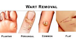 Best Sellers in Wart Removal Products