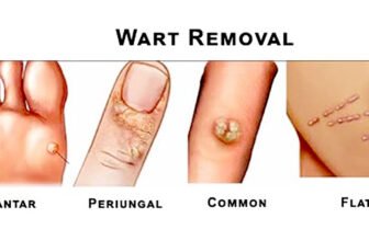 Best Sellers in Wart Removal Products