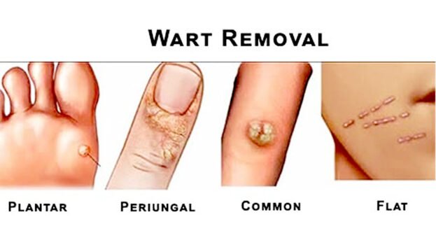 Best Sellers in Wart Removal Products