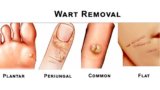 Wart Removal Products
