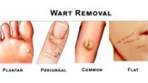 Wart Removal Products
