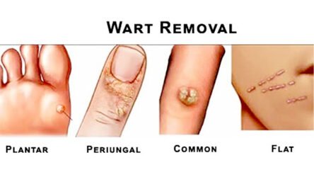 Wart Removal Products